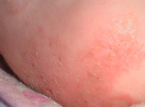如何预防湿疹有效