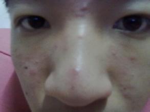 鼻子上长痘是什么原因