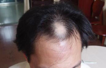 别对斑秃失去信心