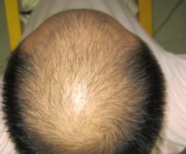  脂溢性脱发有哪些症状特点