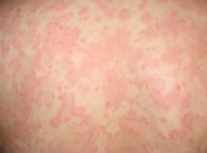 什么是过敏性荨麻疹