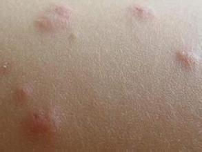 湿疹经常出现在哪些部位