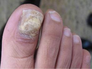 灰指甲症状表现在哪些方面